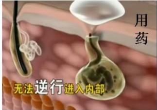 用药无法逆行内部 用药.jpg